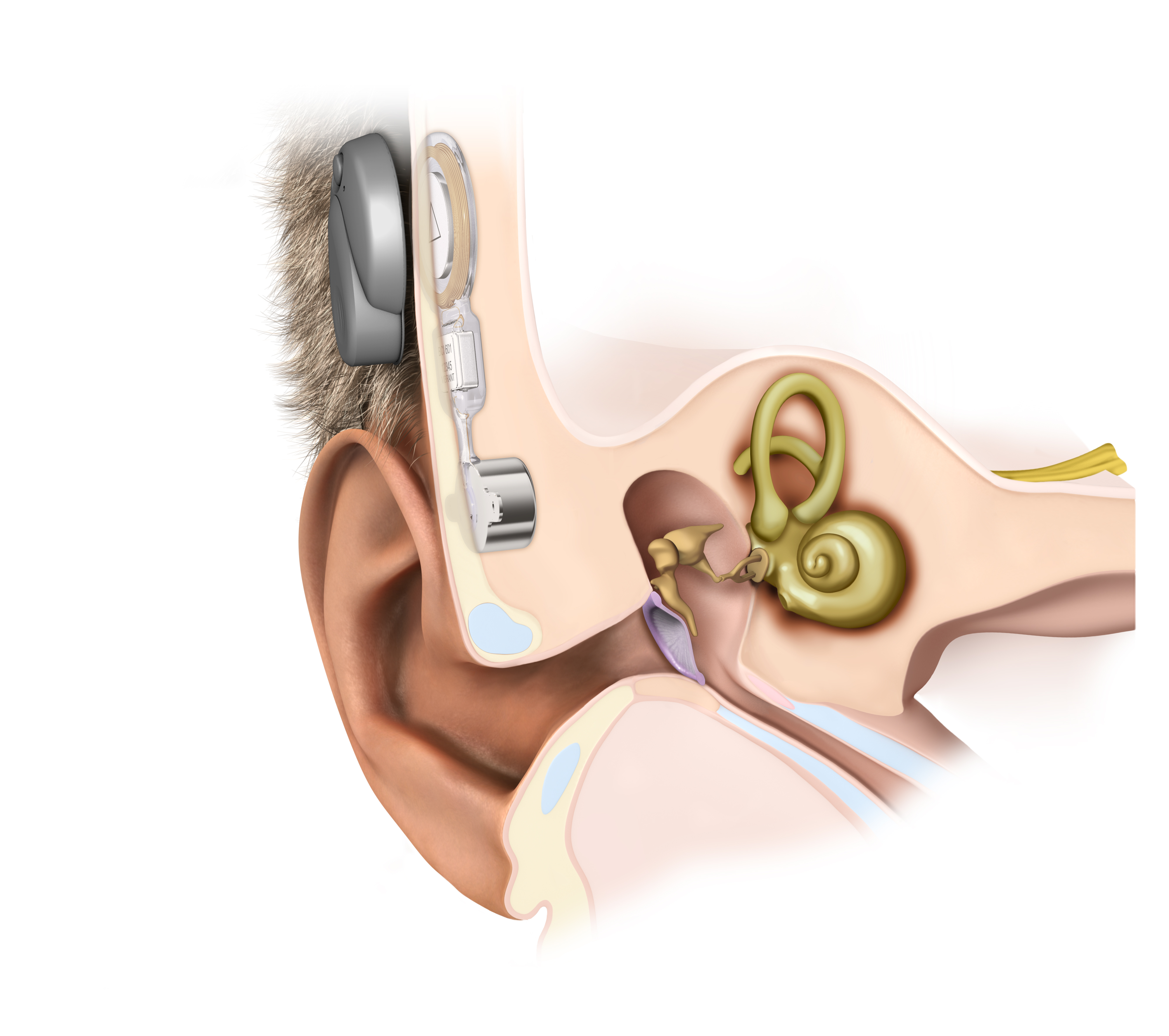 Bonebridge | Hearing implants